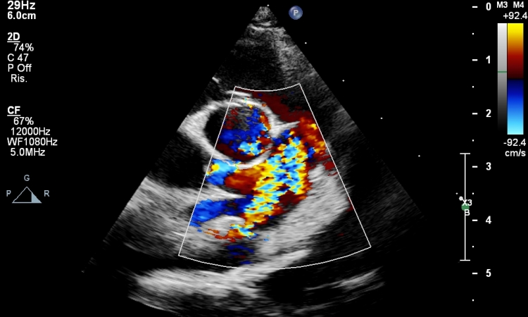 IL DOTTO ARTERIOSO PERVIO (PDA)